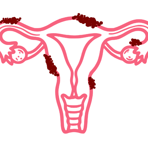 Endometriose